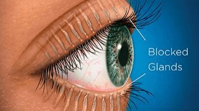 Chart Illustrating Blocked Glands in an Eye
