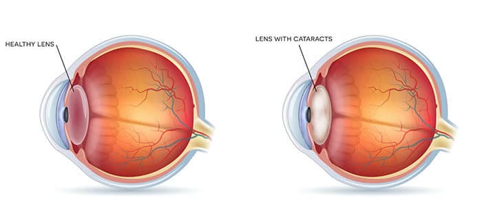 Diagram Illustrating a Healthy Eye Vs One With a Cataract