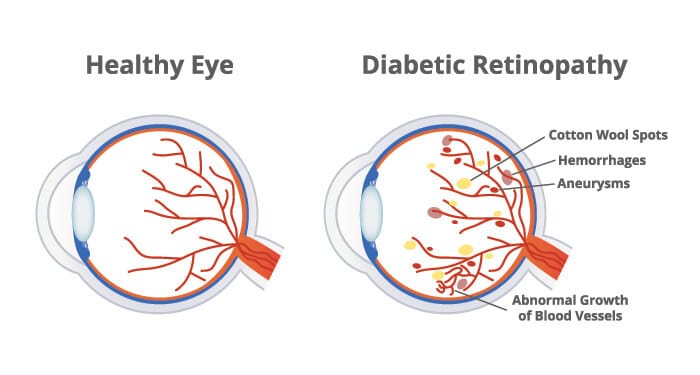 Chart Illustrating a Healthy Eye Compared to One With Diabetic Retinopathy