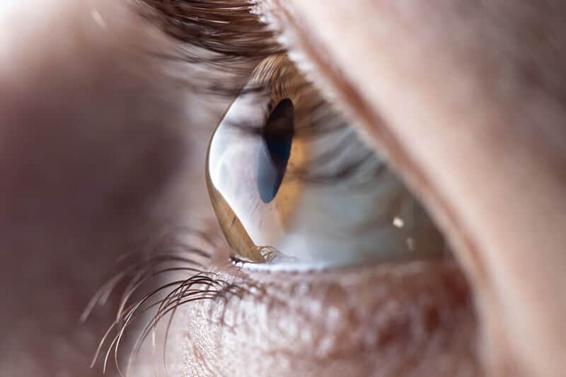 Closeup of an Eye With Keratoconus